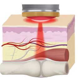 ED & PD Single treatment session , EMTT, ESWT, Infrared Light with Carboxy Co2